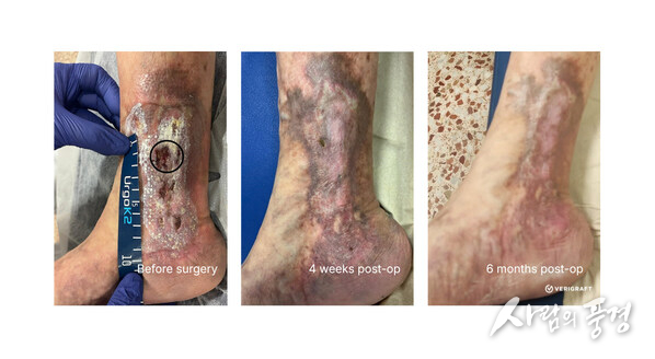 Restorative effect of replacing diseased vein with fully biological P-TEV personalized tissue engineered vein